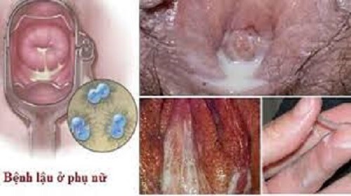 Bệnh lậu ở phụ nữ